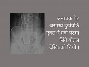 युवकको पेटबाट शल्यक्रिया गरी निकालियो रक्सीको सिंगो बोतल