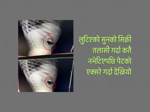 महिलाको सिक्री लुटियो, एक्सरे गर्दा पेटमा देखियो