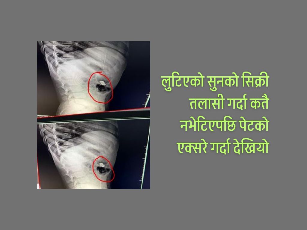 महिलाको सिक्री लुटियो, एक्सरे गर्दा पेटमा देखियो